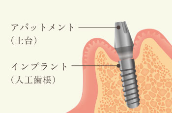 アバットメント（土台）インプラント（人工歯根）