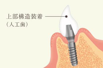 上部構造装着（人工歯）