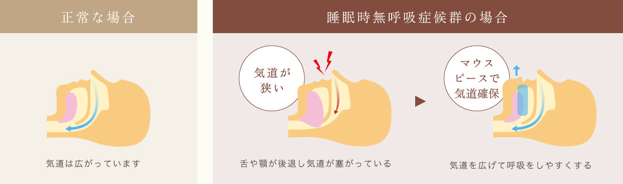 正常な場合は気道は広がっています。睡眠時無呼吸症候群の場合は舌や顎が後退し気道が塞がっているので気道を広げて呼吸をしやすくします。